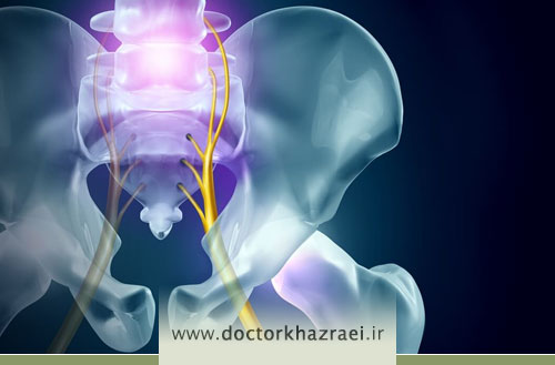 درمان و کاهش دردهای سیاتیک توسط متخصص طب سوزنی