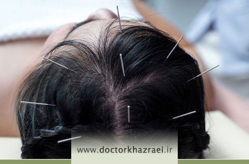 اثرات طب سوزنی در درمان ریزش مو؛ تقویت و رویش مو