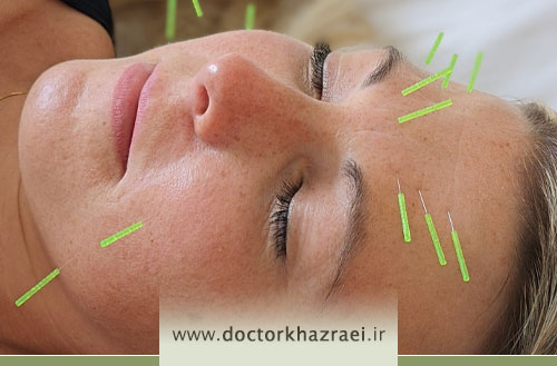 اثرات طب سوزنی در رفع خطوط و چروک های اطراف لب و دهان