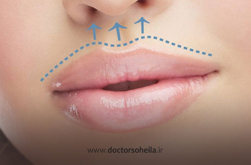 لیفت لب با جراحی سانترال؛ مزایا، مراحل و ماندگاری