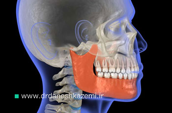درمان انحراف فک بالا و پایین؛ اصلاح کجی فک