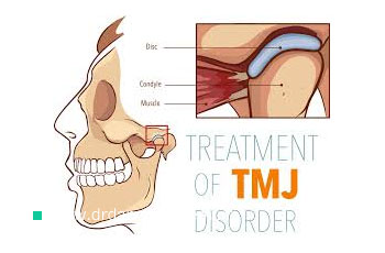 درمان مشکلات و اختلالات مفصل فکی گیجگاهی (TMJ)