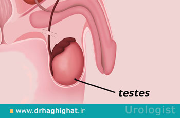 عمل برگشت وازکتومی چیست و چگونه انجام می شود؟