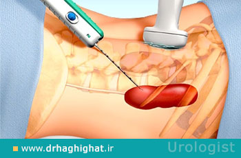 نقش بیوپسی در تشخیص دقیق تومور کلیه