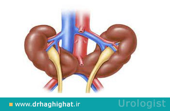 کلیه نعل اسبی چیست و چه عوارض و خطراتی دارد؟