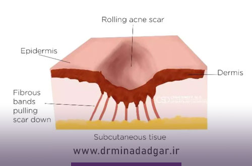 سابسیژن چیست وچه تاثیری بر درمان جای جوش دارد؟