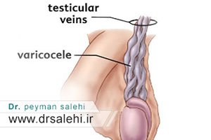 با واریکوسل در کودکان و نوجوانان آشنا شوید