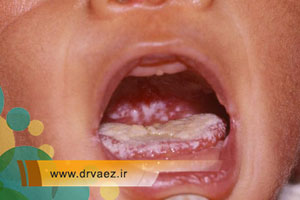 علل و راههای درمان سریع برفک دهان نوزادان و بزرگسالان