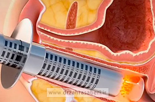 مزایا و معایب لیزر مونالیزا برای خشکی واژن