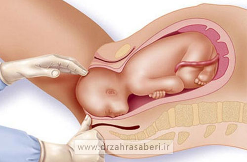 عمل زیبایی واژن بعد از زایمان طبیعی