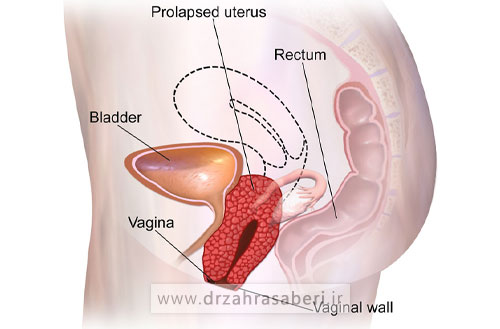 افتادگی رحم چیست و چه علائمی دارد؟