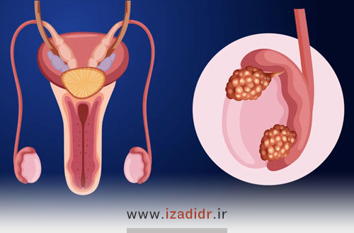 دانستنیهای سرطان بیضه و راههای درمان آن