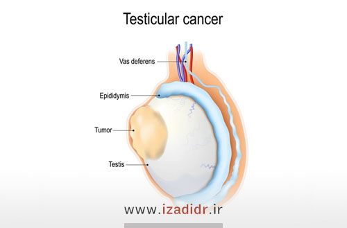 تاثیرات سرطان بیضه بر باروری مردان چیست؟