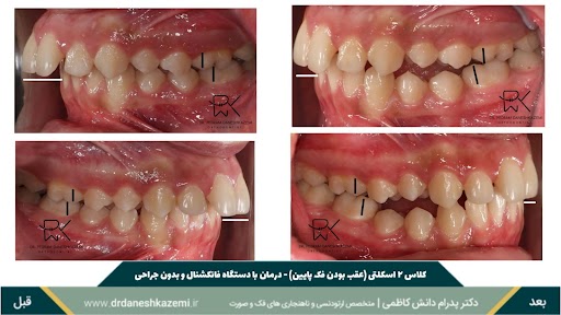 نمای بسته دندانها قبل و بعد از درمان