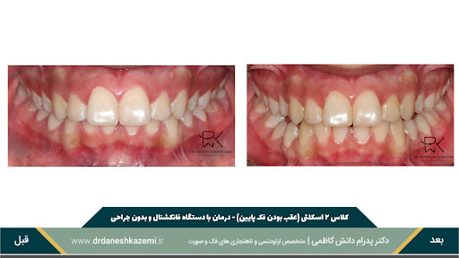 نمای بسته دندانها از روبرو قبل و بعد از درمان