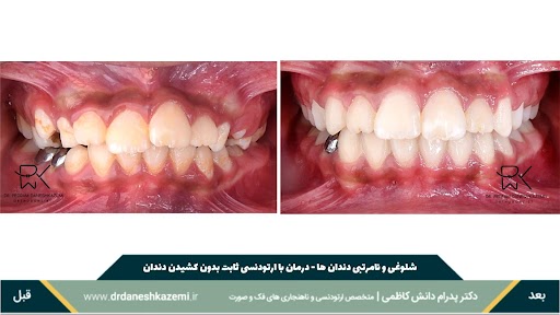 نمای بسته دندانها از روبرو قبل و بعد از درمان