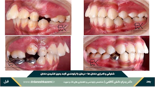 نمای بسته دندانها از نیمرخ قبل و بعد از درمان