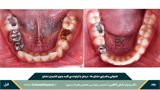 نمای بسته فک پایین قبل و بعد از درمان