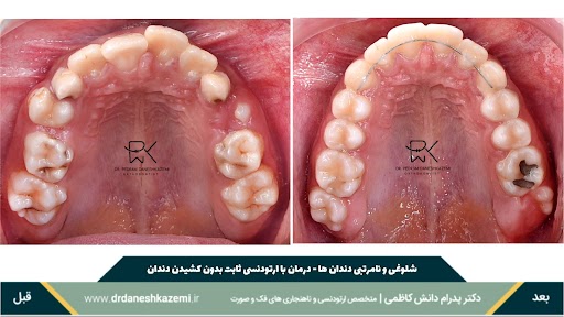 نمای بسته فک بالا قبل و بعد از درمان