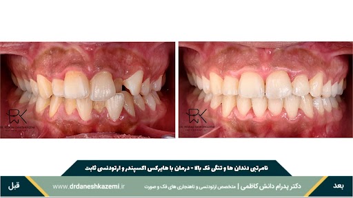 نمای بسته دندانها از روبرو قبل و بعد از درمان