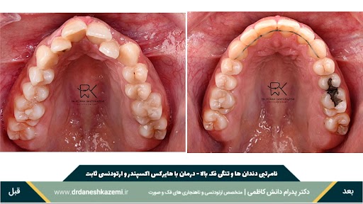 نمای بسته فک بالا قبل و بعد از درمان