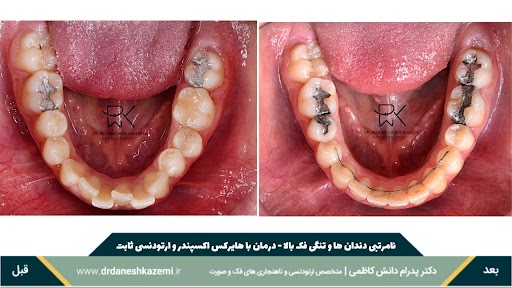 نمای بسته فک پایین قبل و بعد از درمان