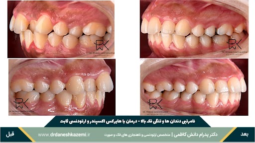 نمای بسته دندانها از نیمرخ قبل و بعد از درمان