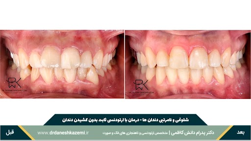 نمای بسته دندانها از روبرو قبل و بعد از درمان