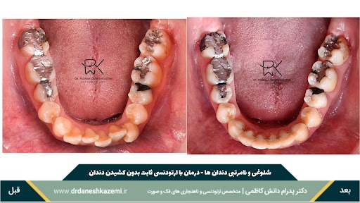 نمای بسته فک پایین قبل و بعد از درمان