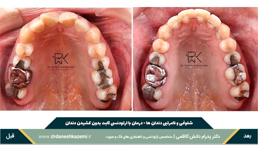 نمای بسته فک بالا قبل و بعد از درمان