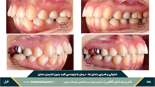 نمای بسته نیمرخ دندانها قبل و بعد از درمان