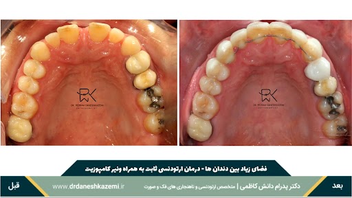 نمای بسته فک بالا قبل و بعد از درمان