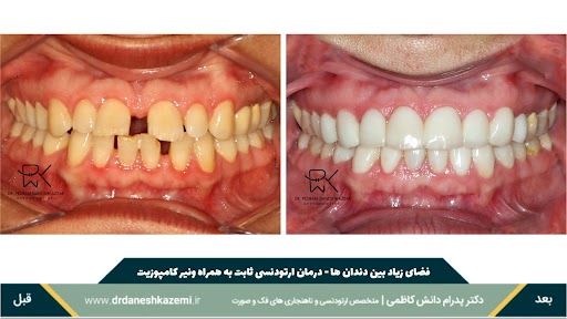 نمای بسته دندانها از روبرو قبل و بعد از درمان