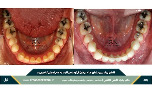 نمای بسته فک پایین قبل و بعد از درمان