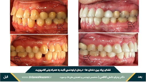 نمای نیمرخ دندانها قبل و بعد از درمان