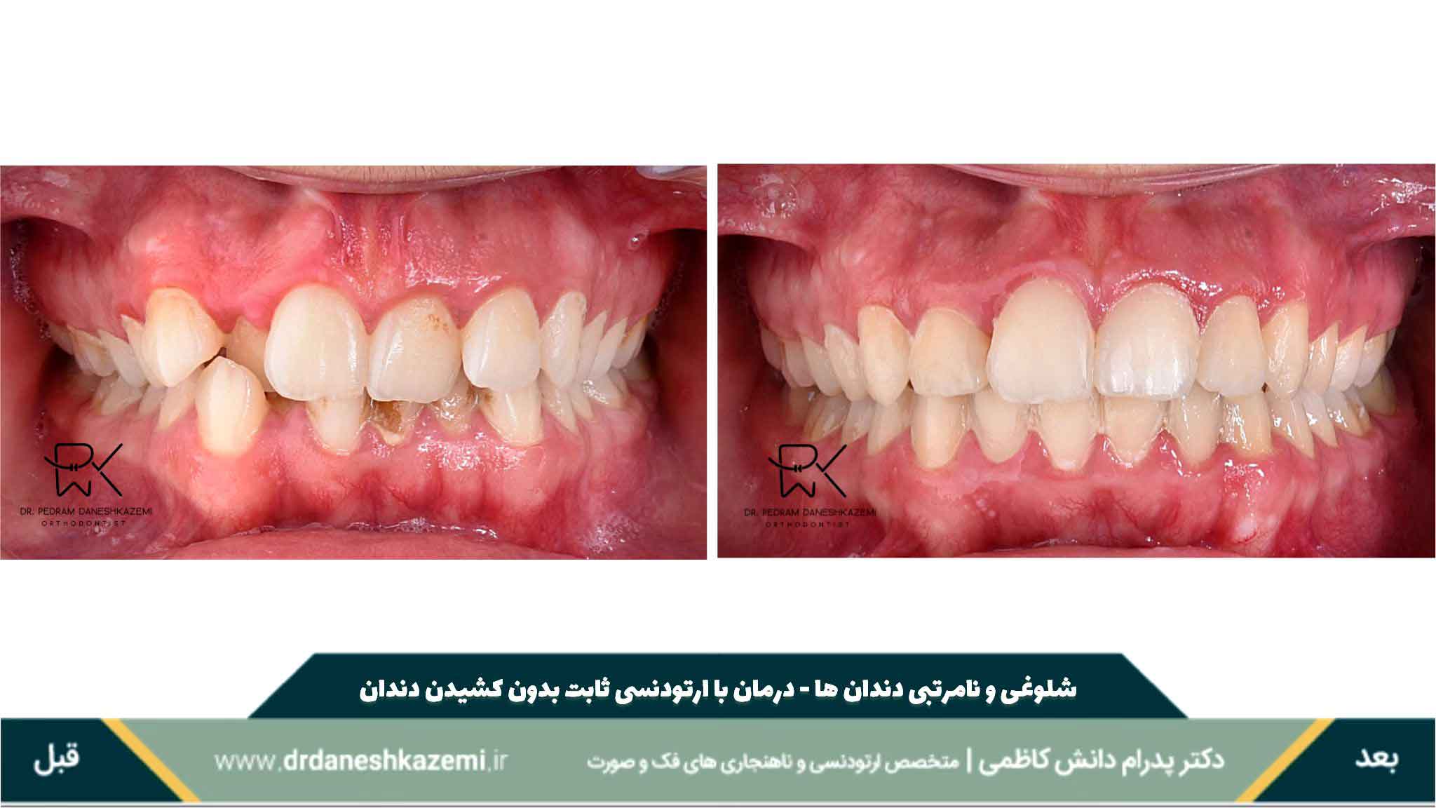 نمای بسته دندانها از روبرو قبل و بعد از درمان