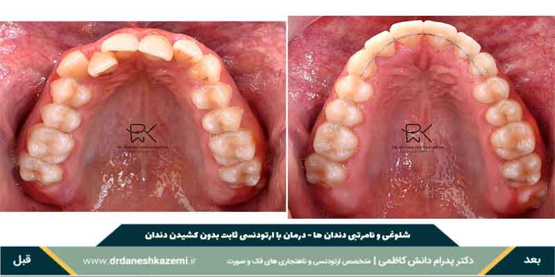 قبل و بعد از درمان نا مرتبی فک بالا