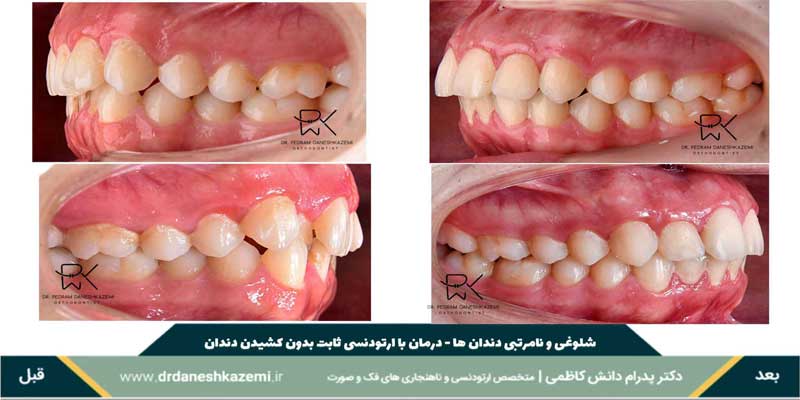 شلوغی و نامرتبی دندان های جلو