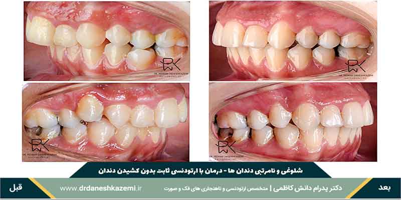 درمان نامرتب بودن دندانها با ارتودنسی