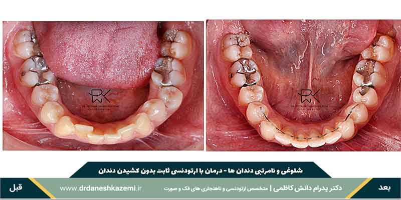 مرتب و ردیف شدن دندان ها با ارتودنسی