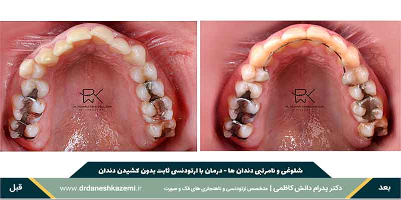 درمان ناهنجاری‌ های دندانی و فکی با ارتودنسی