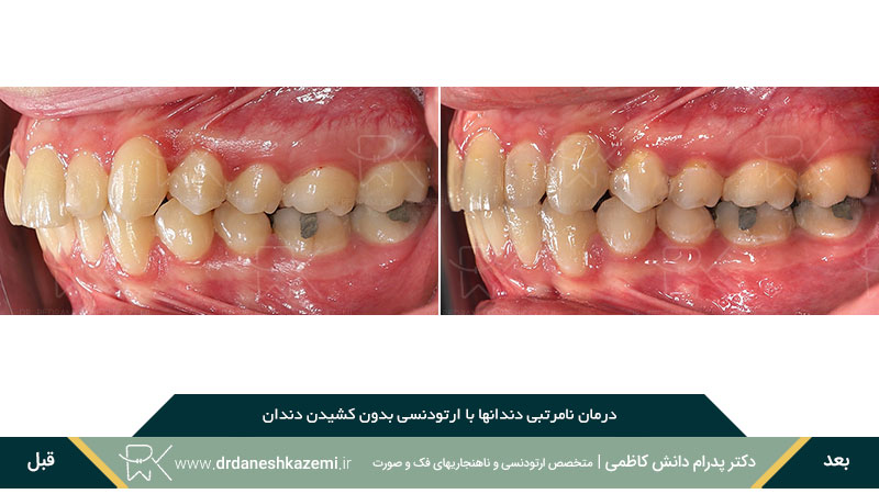 عکس از نمای بسته سه رخ دندانهای ارتودنسی شده