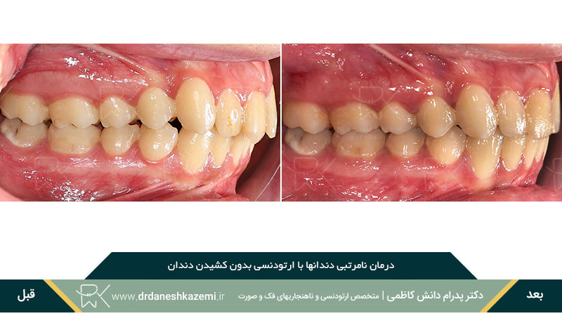 عکس از نمای بسته سه رخ سمت چپ دندان ارتودنسی شده