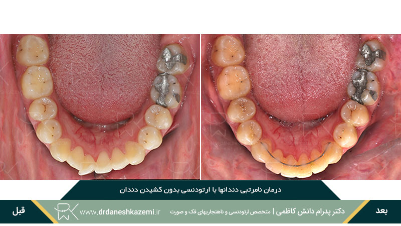 نمای دندانهای فک پایینی پس از ارتودنسی