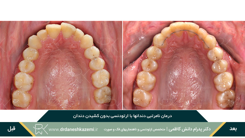 عکس نمونه کار ارتودنسی از فک بالا