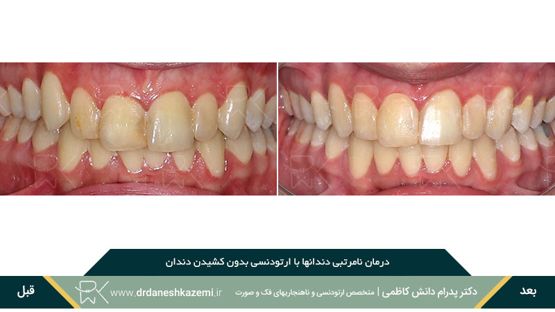 عکس از نمای بسته دندانها پس از ارتودنسی از روبرو