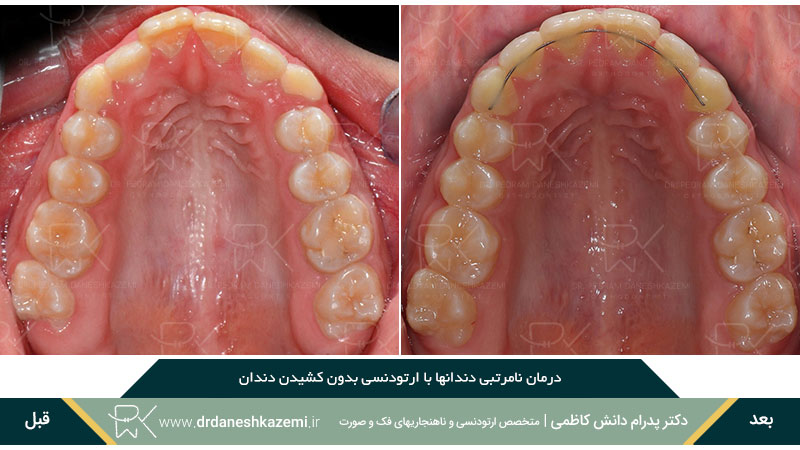 ارتودنسی برای رفع نامرتبی دندان های فک بالا