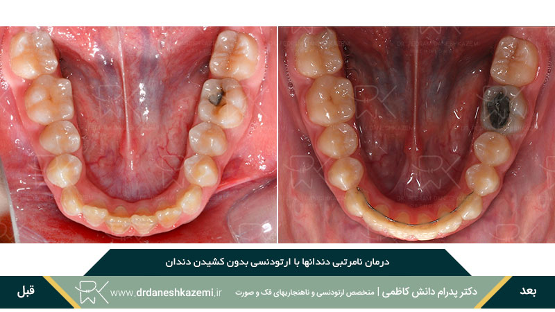 ارتودنسی برای رفع نامرتبی دندان های فک پائین