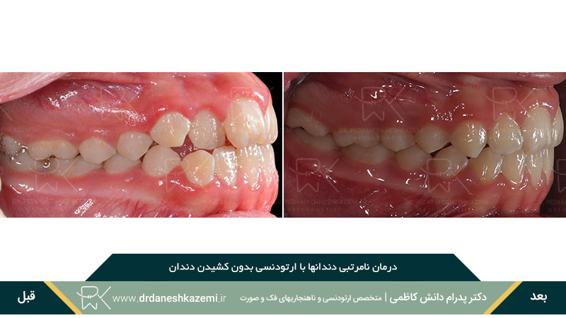 ارتودنسی دندانهای  سمت راست فک بالا و پایین