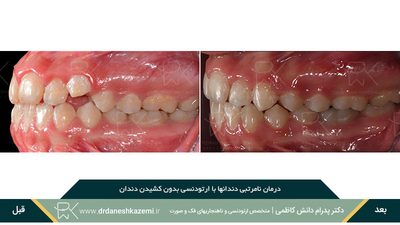 ارتودنسی دندانهای سمت چپ فک بالا و پایین